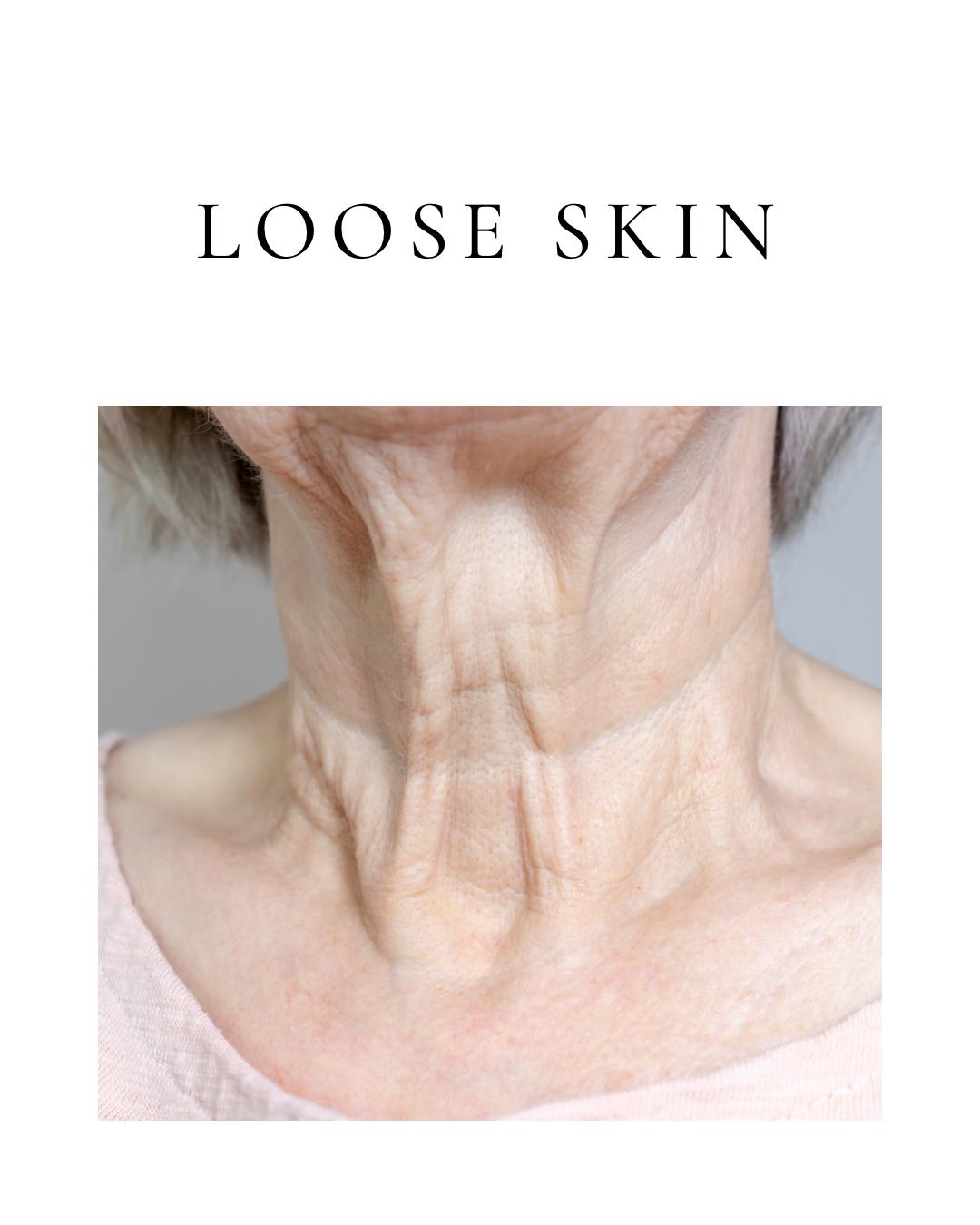 Loose Skin